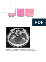 Meningioma