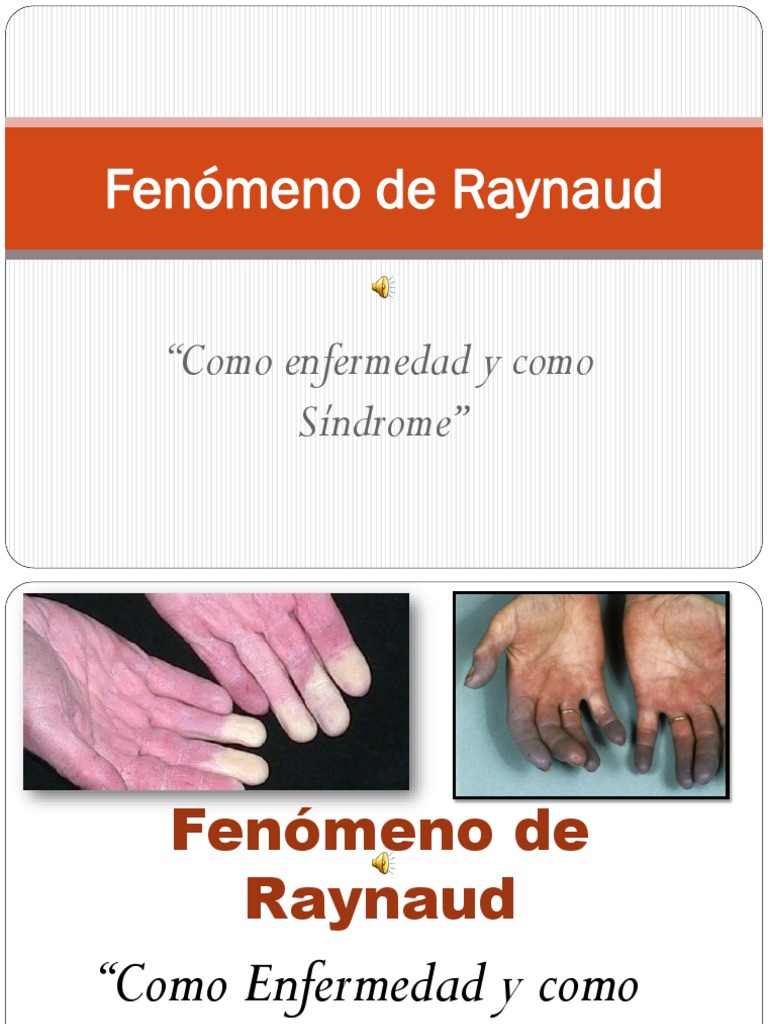 Fenómeno de Raynaud | PDF