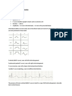 P Wave Abnormalities and Their ECG Signs