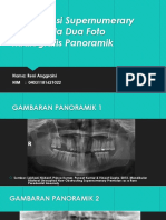 Interpretasi Supernumerary Teeth Pada Dua Foto Radiografis Panoramik