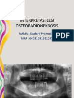 Interpretasi Lesi Osteoradionekrosis: NAMA: Saphira Pramudita NIM: 04031281621037