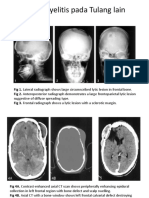 Gambaran Radiologi Osteomielitis