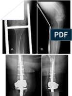 Fx Supracondilea Femur