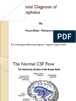 Hydrocephalus-1