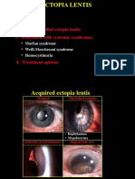 Ectopia Lentis: 1. Acquired 2. Isolated Familial Ectopia Lentis 3. Associated With Systemic Syndromes