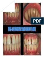 Supra and Subgingival Scaling 2013