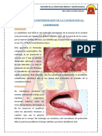 Candidiasis