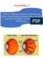Pengertian Glaukoma