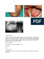 Complex Odontoma