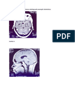 Berikut Adalah Beberapa Gambaran Radiologi Pada Meningitis Tuberkulosa