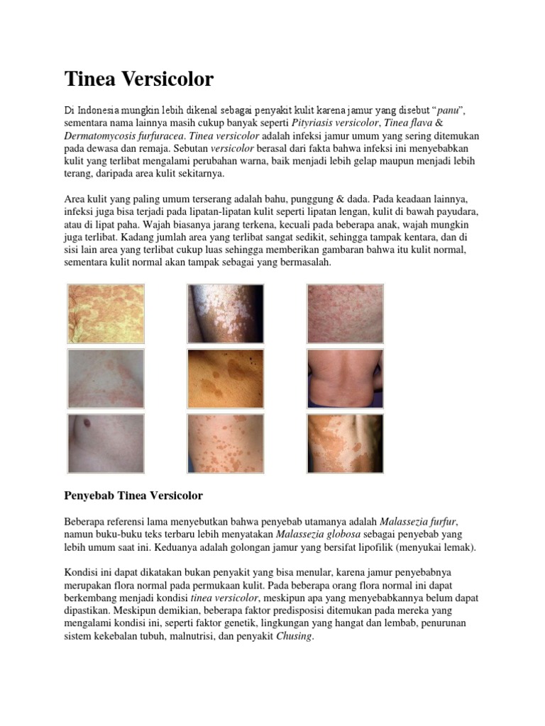 Tinea Versicolor PDF