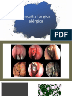 Sinusitis Fúngica Alérgica