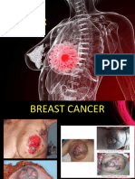 Breast Cancer