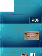 Aclaramiento Dental Interno