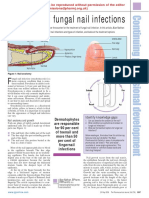 Treatment of Fungal Nail Infections