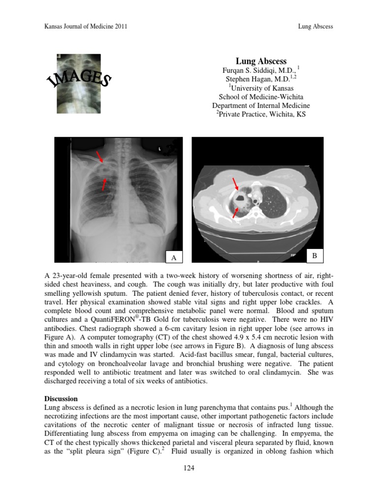 Lung Abscess | PDF