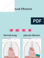 Pleural Effusions (2)