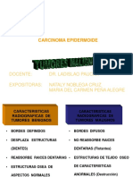 Carcinoma de reborde alveolar