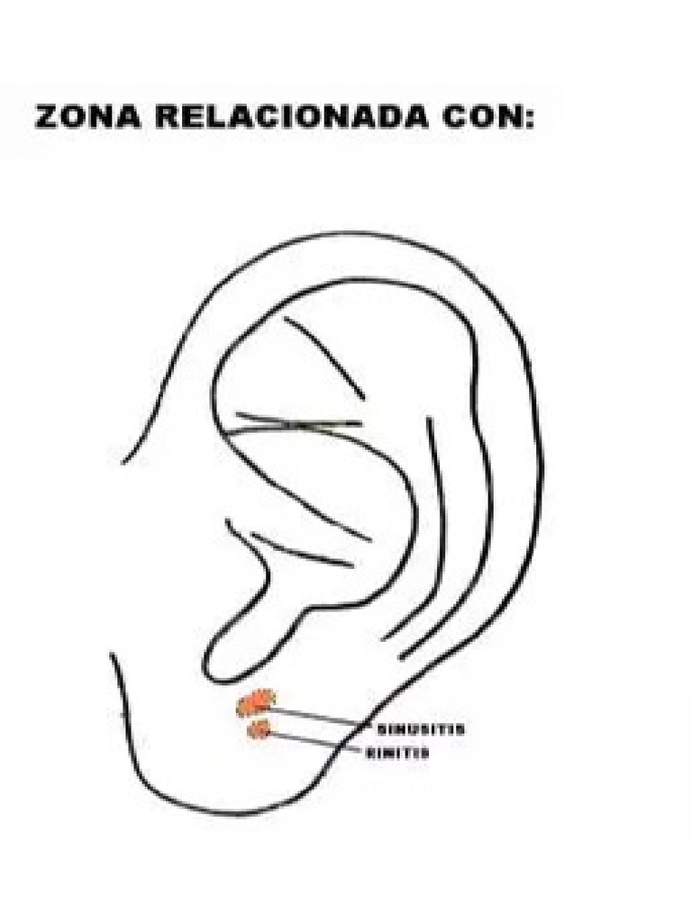 Auriculoterapia Zona Sinusitis Rinitis PDF