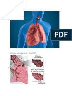 Tuberculosis Mila