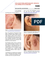 Excision of Preauricular Pits and Sinuses