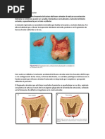 Operculectomía: Procedimiento y Técnicas | PDF | Cirugía | Cuidado de ...