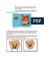 Fractura Del Hueso Alveolar