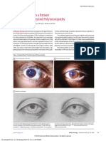 Scalloped Pupil in A Patient With Familial Amyloid Polyneuropathy