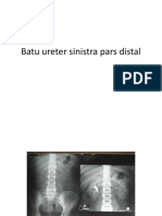 Batu Ureter Sinistra Pars Distal