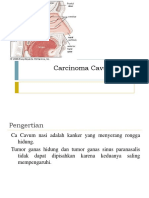 Carcinoma Cavum Nasi
