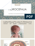 Hidrocefalia y Meningitis