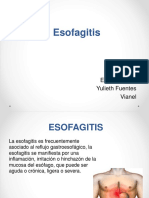 Esofagitis
