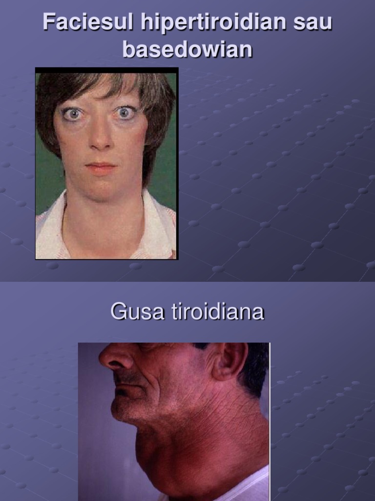 Facies in Thyroid and Endocrine Disorders | PDF