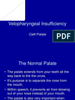 Velopharyngeal Insufficiency: Cleft Palate