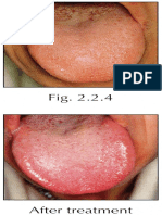 Tongue before and after needling