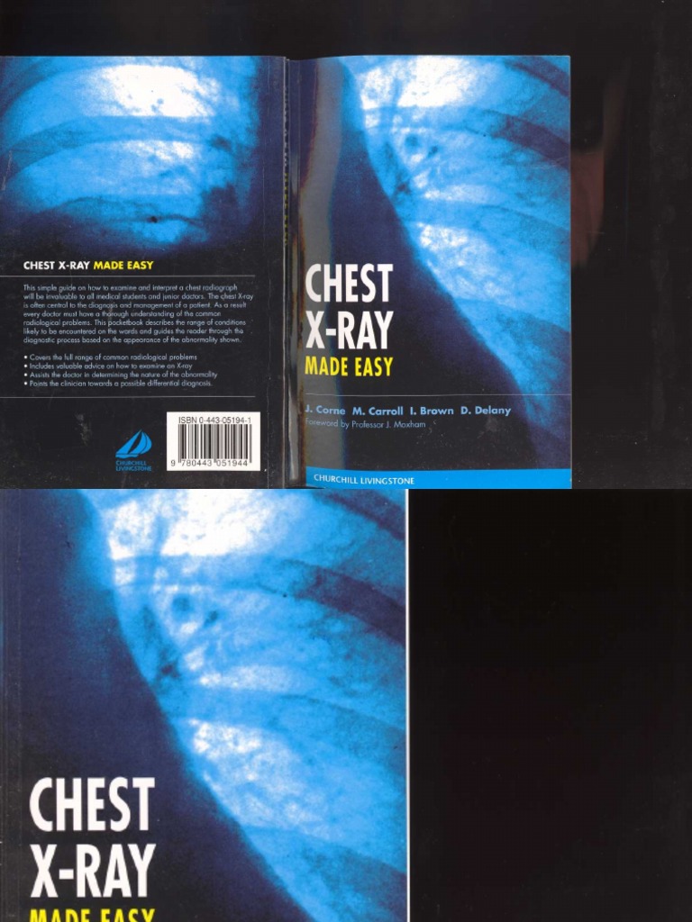 Chest X-Ray Made Easy PDF | PDF