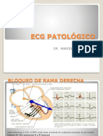 Ecg Patológico