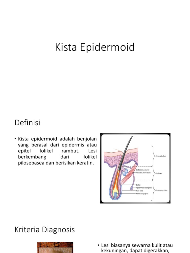 Kista Epidermoid | PDF