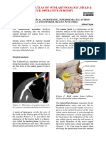 Caldwell Luc _radical antrostomy_ procedure canine fossa and inferior meatal puncture and inferior meatal antrostomy.pdf