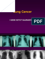 Lung Cancer: I Gede Ketut Sajinadiyasa