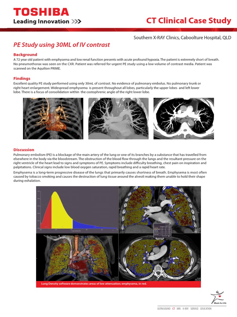 PE Study Using 30mL of IV Contrast | Download Free PDF | Lung | Chronic ...