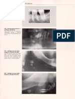 1.calcificari Dupa Parotidita Epidemica