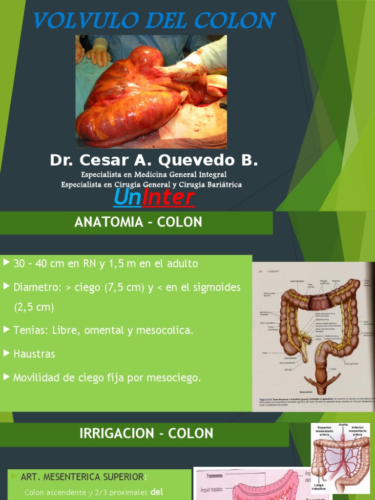 Vólvulo de Colon: Diagnóstico y Tratamiento | PDF | Intestino grueso ...