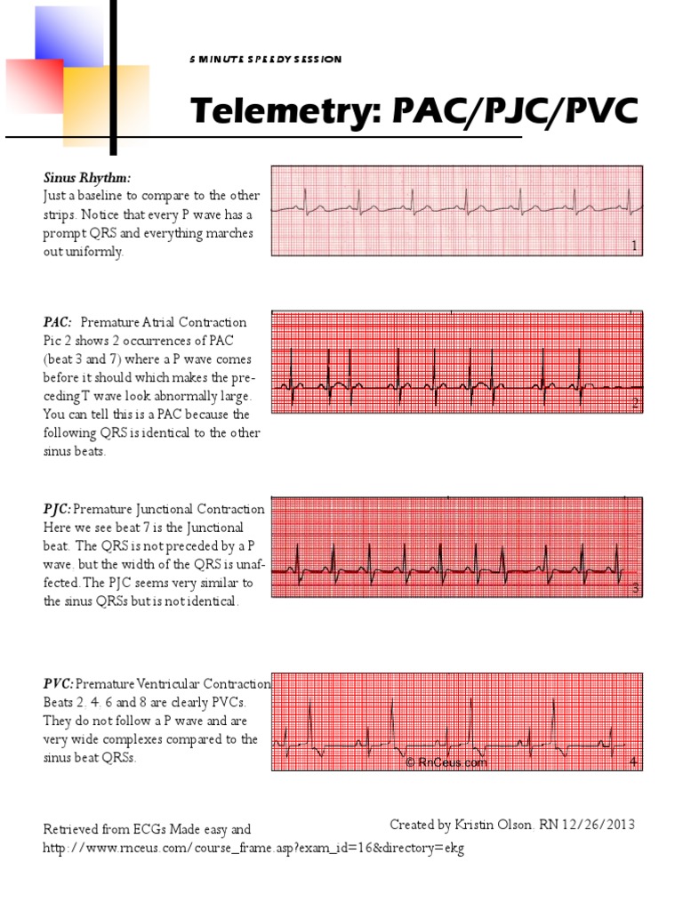 Pac Pjc Pvc Cardiac Electrophysiology Cardiac Arrhythmia