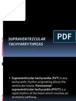 Types and Symptoms of Supraventricular Tachycardias