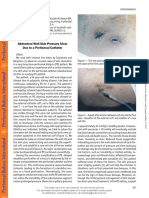 Abdominal Wall Skin Pressure Ulcer Due To A Peritoneal Catheter