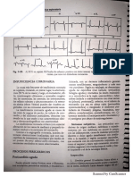 Pericarditis Aguda