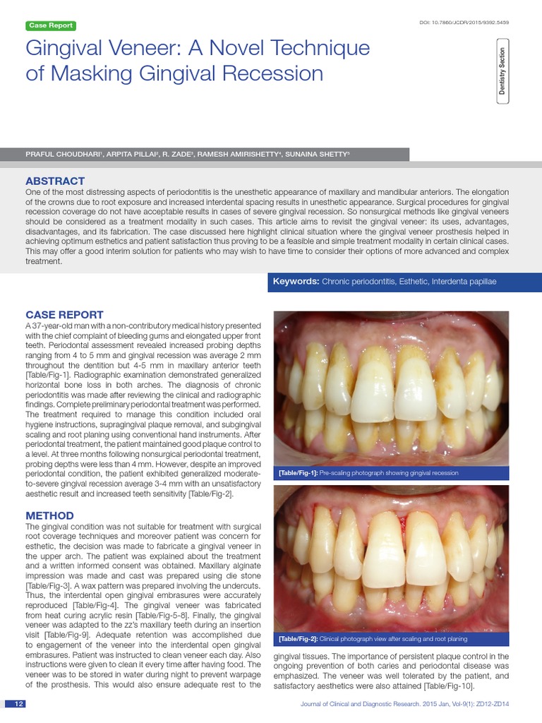 Gingival Veneer A Novel Technique of Masking Gingival Recession PDF