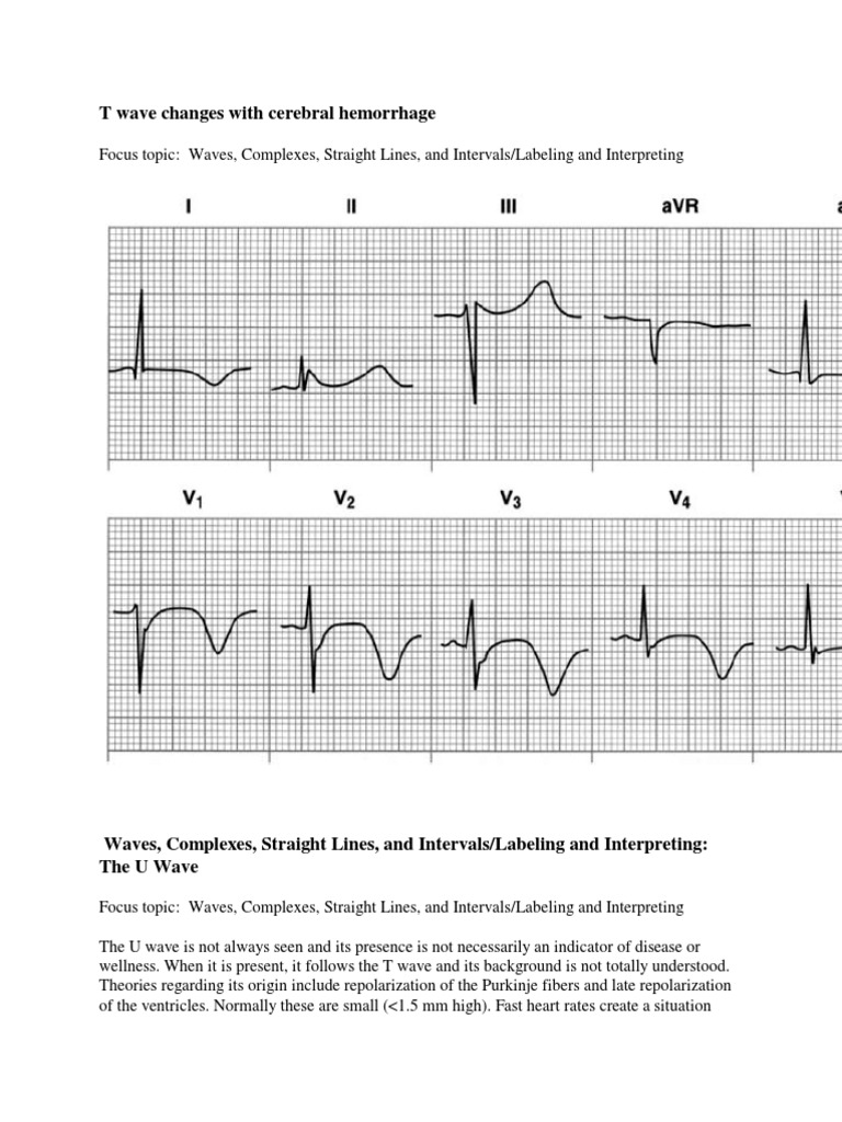 T Wave & U Wave | PDF