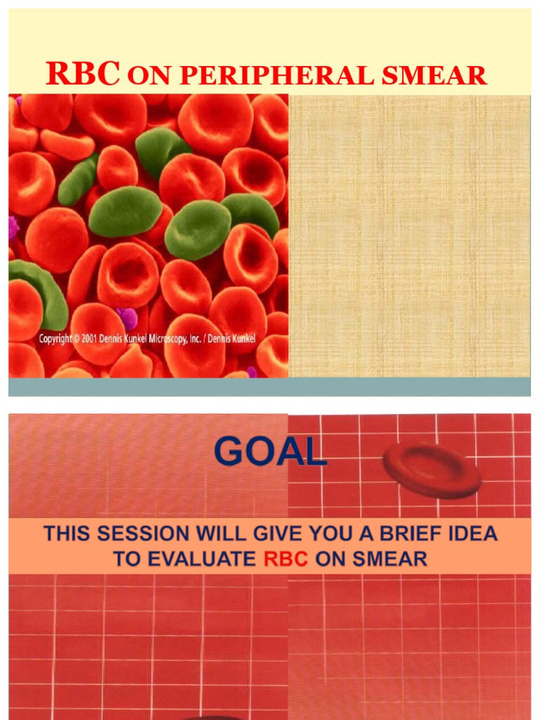 RBC On Smear | PDF | Anemia | Red Blood Cell